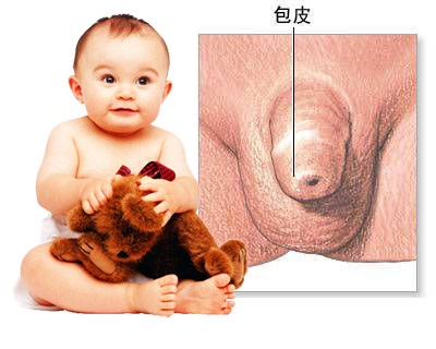圖中包含了兩張圖片，有個手持毛公仔的嬰兒，和一張嬰兒陰莖的插圖，有一條線指著包皮的位置。